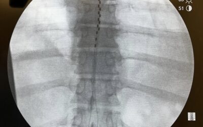 Spinal cord stimulation trial