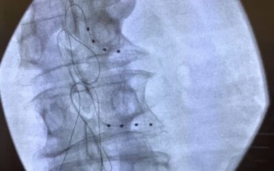 Stimulation for Neuropathic Knee Pain