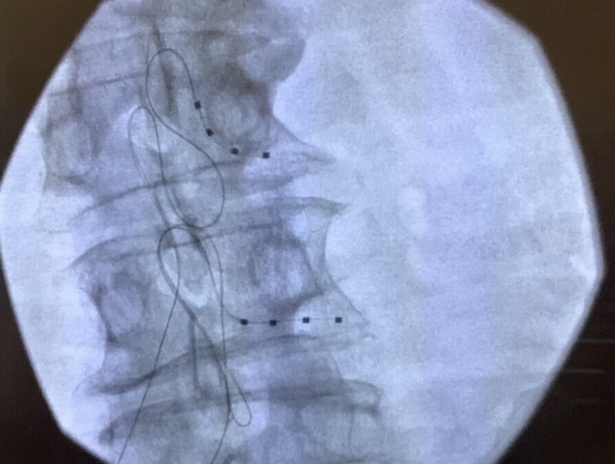 Stimulation for Neuropathic Knee Pain