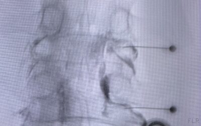 Epidural Steroid Injection, Transforaminal Approach